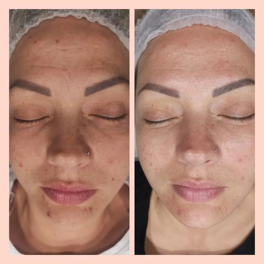 Cholley BIOCLEAN G3 Mask - Exfoliating, Purifying & Peeling Mask